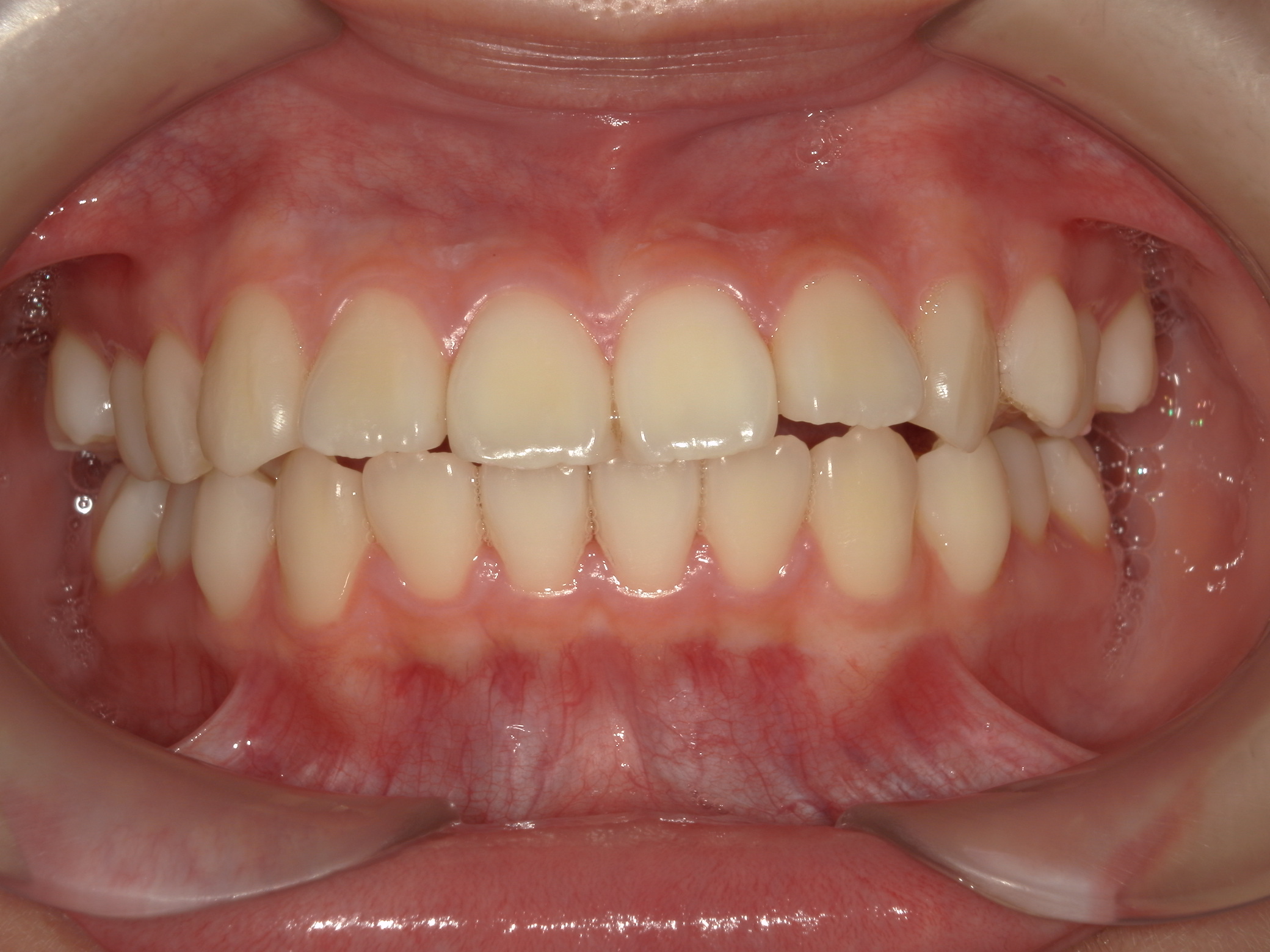 非抜歯拡大矯正(床矯正）の犠牲者が来院