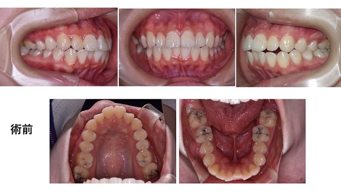 矯正症例83　上下顎前突、ガミースマイル、 北秋田市、秋田市、大館市、能代市、秋田県