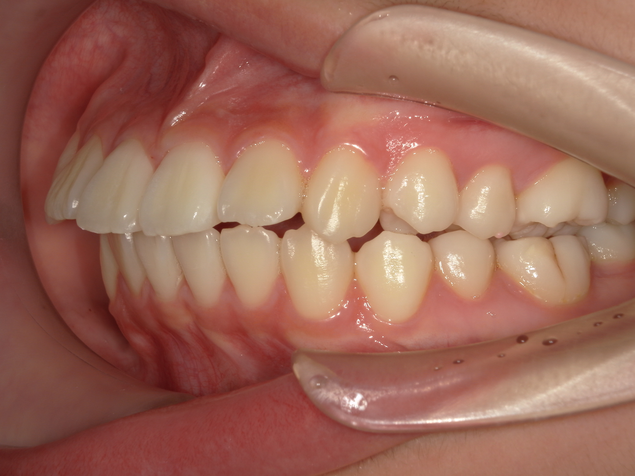 非抜歯拡大矯正(床矯正）の犠牲者が来院