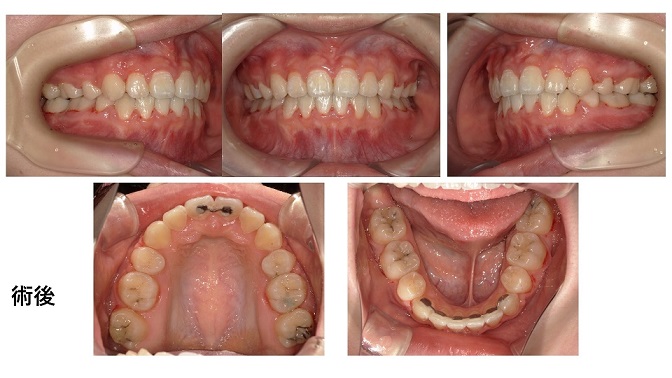矯正症例83　上下顎前突、ガミースマイル、 北秋田市、秋田市、大館市、能代市、秋田県