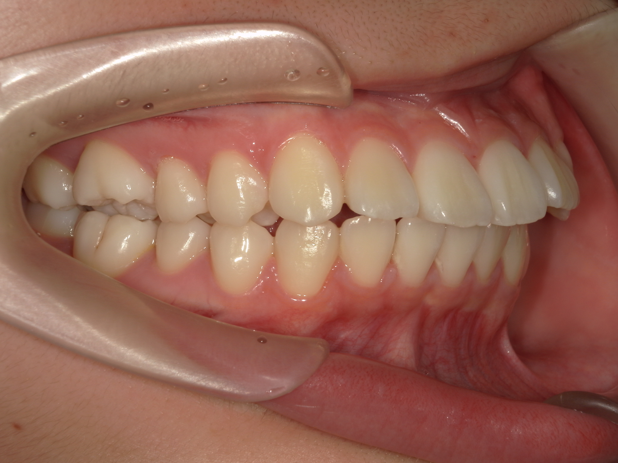 非抜歯拡大矯正(床矯正）の犠牲者が来院