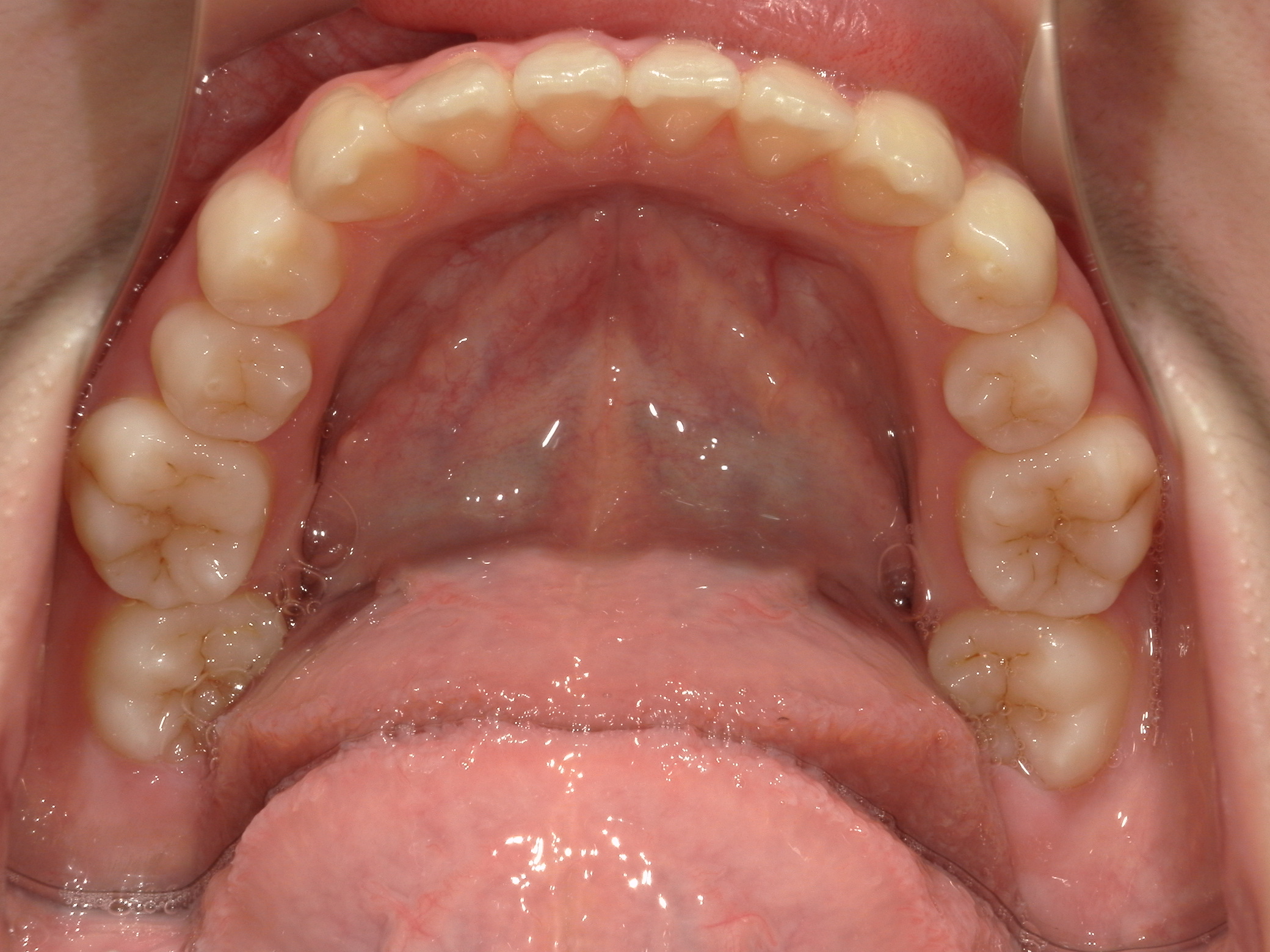 非抜歯拡大矯正(床矯正）の犠牲者が来院