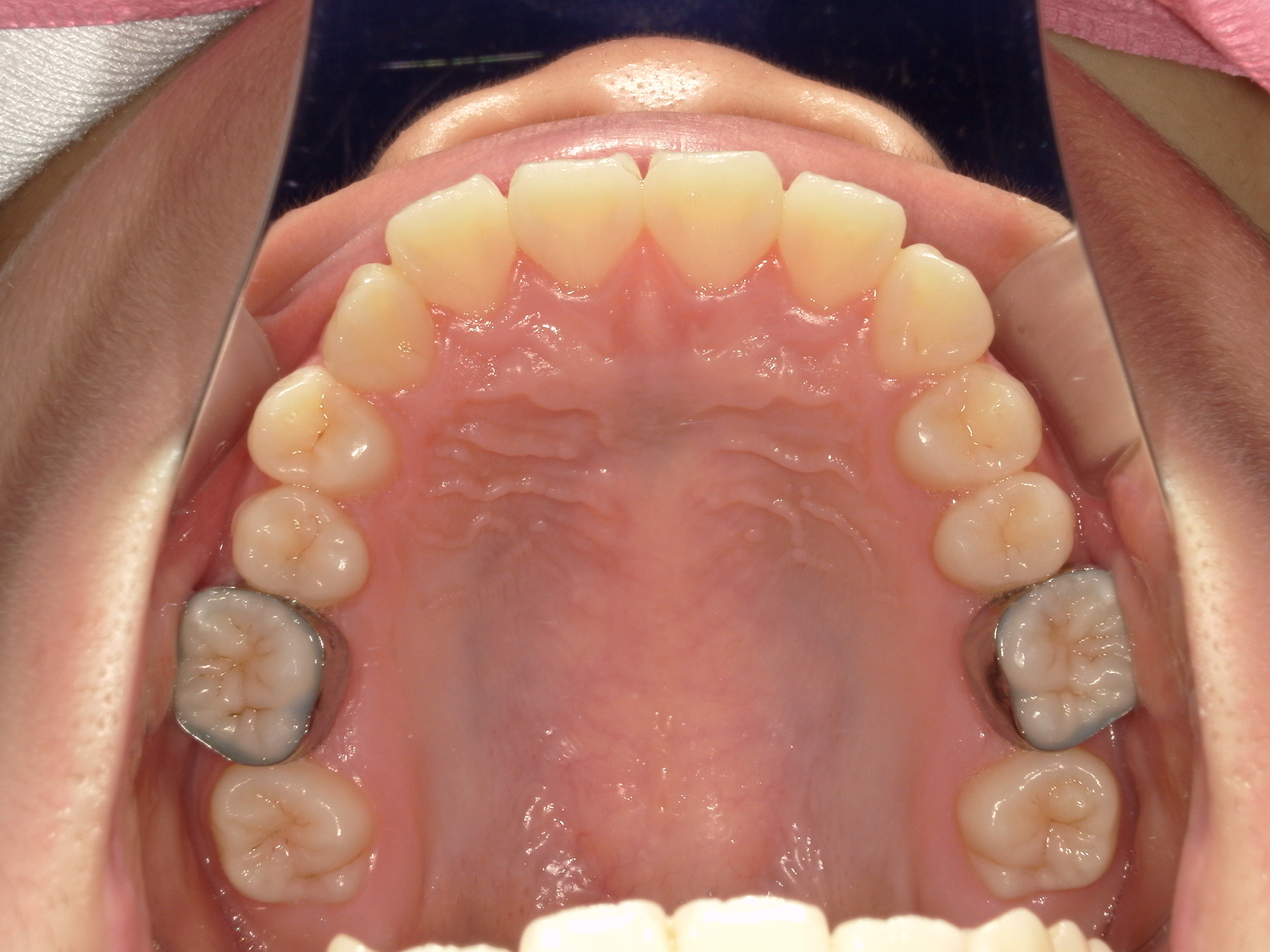非抜歯拡大矯正(床矯正）の犠牲者が来院