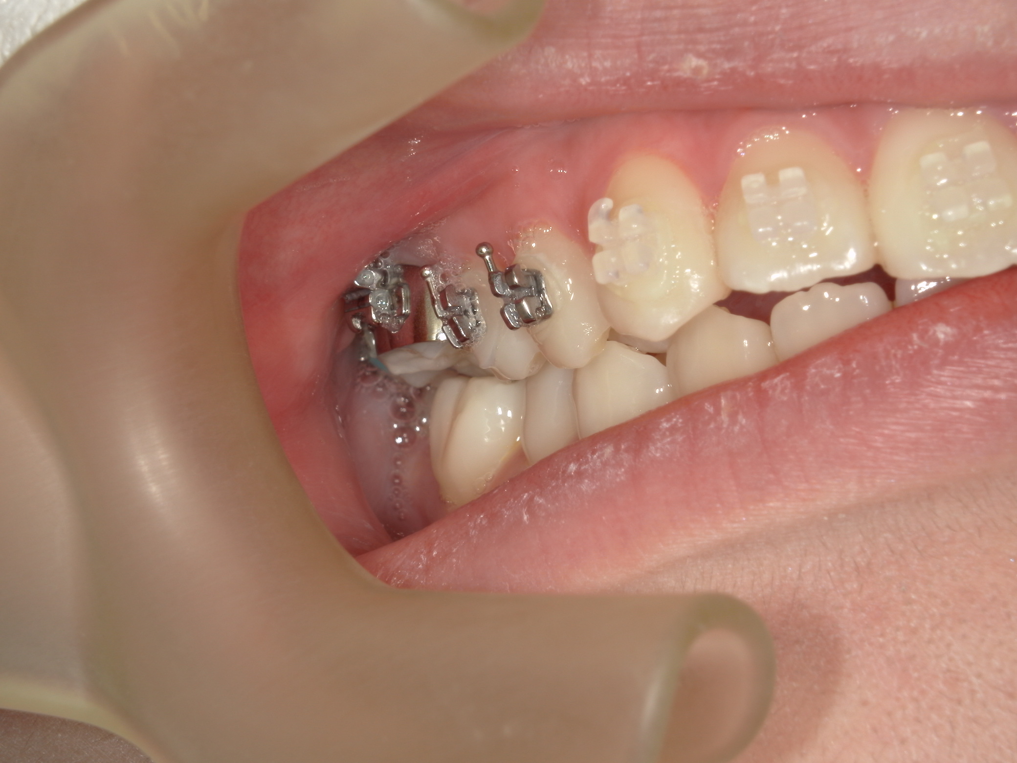 非抜歯拡大矯正(床矯正）の犠牲者が来院