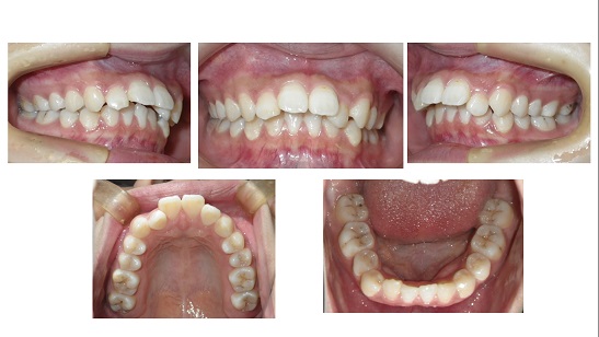 矯正症例52　上顎前突　他院のやり直し症例　インチキ矯正