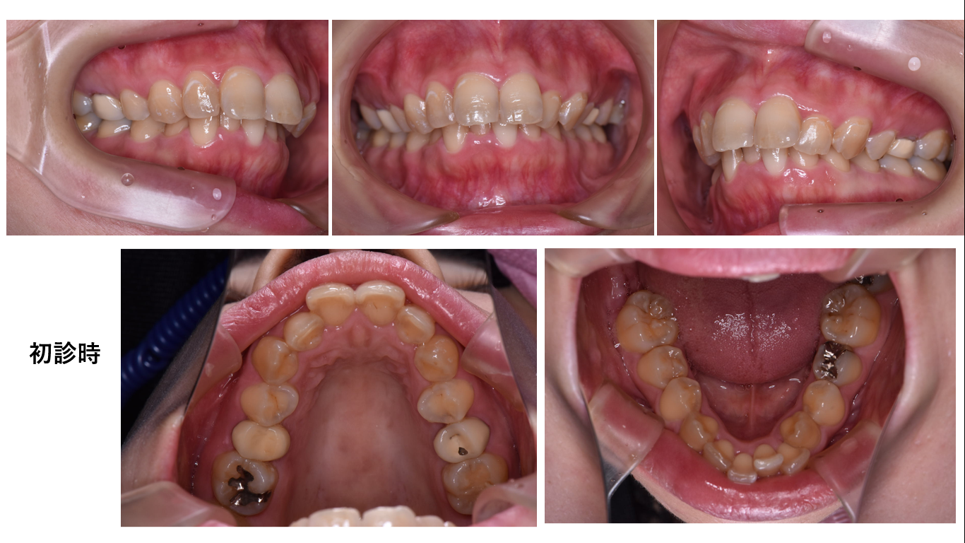 矯正症例145 叢生を伴うAngleⅡ級1類上顎前突