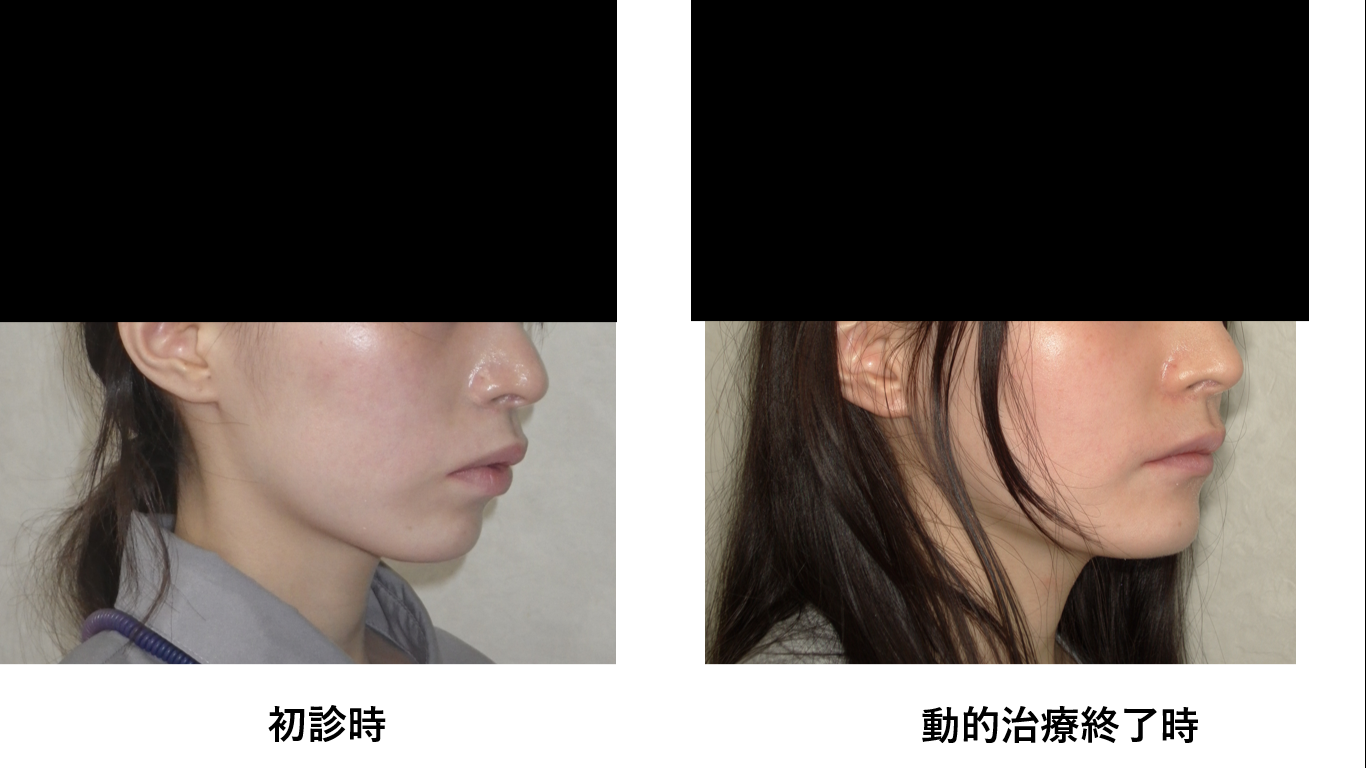 矯正症例132 AngleⅡ級2類上顎前突、再治療症例、能代市、大館市、北秋田市、秋田市