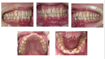 矯正ブログ２　上下顎前突 叢生