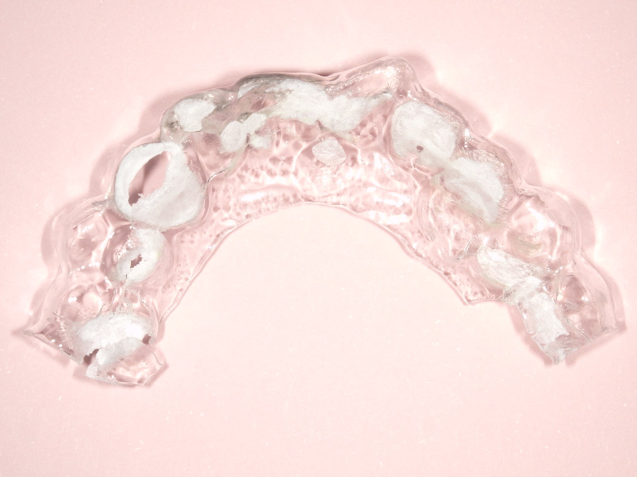 歯ぎしりのある患者にインプラントをして１４年経過