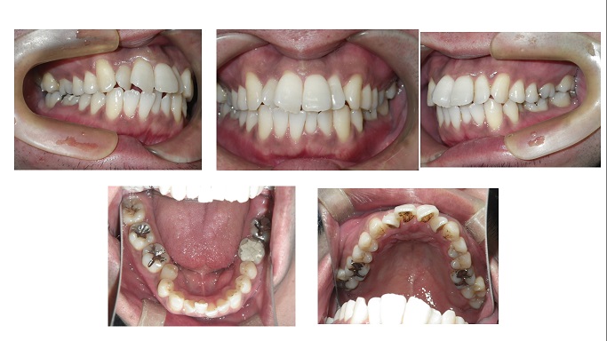 矯正症例５０　上下顎前突　叢生　能代市　北秋田市　大館市