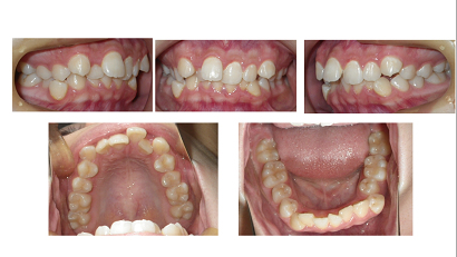 矯正ブログ３　叢生　上顎前突