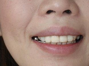 銀歯を白い歯へ換えました。オールセラミック、ジルコニア、ダイレクトボンディング