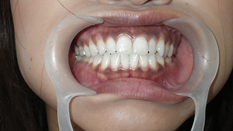 ホワイトニングした後、歯茎の黒ずみ（メラニン）除去です。