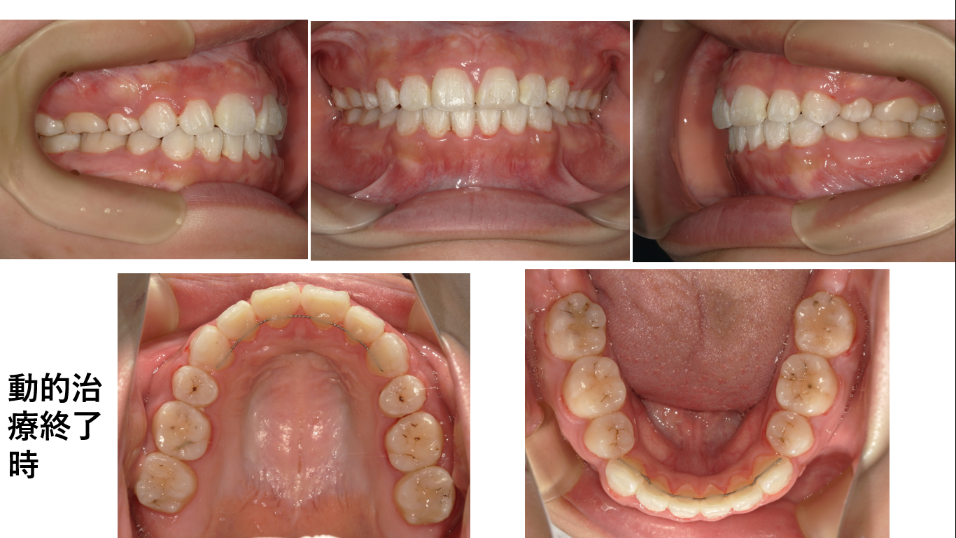 矯正症例141 AngleⅠ級 上下顎前突、ガミースマイル、口ごぼ