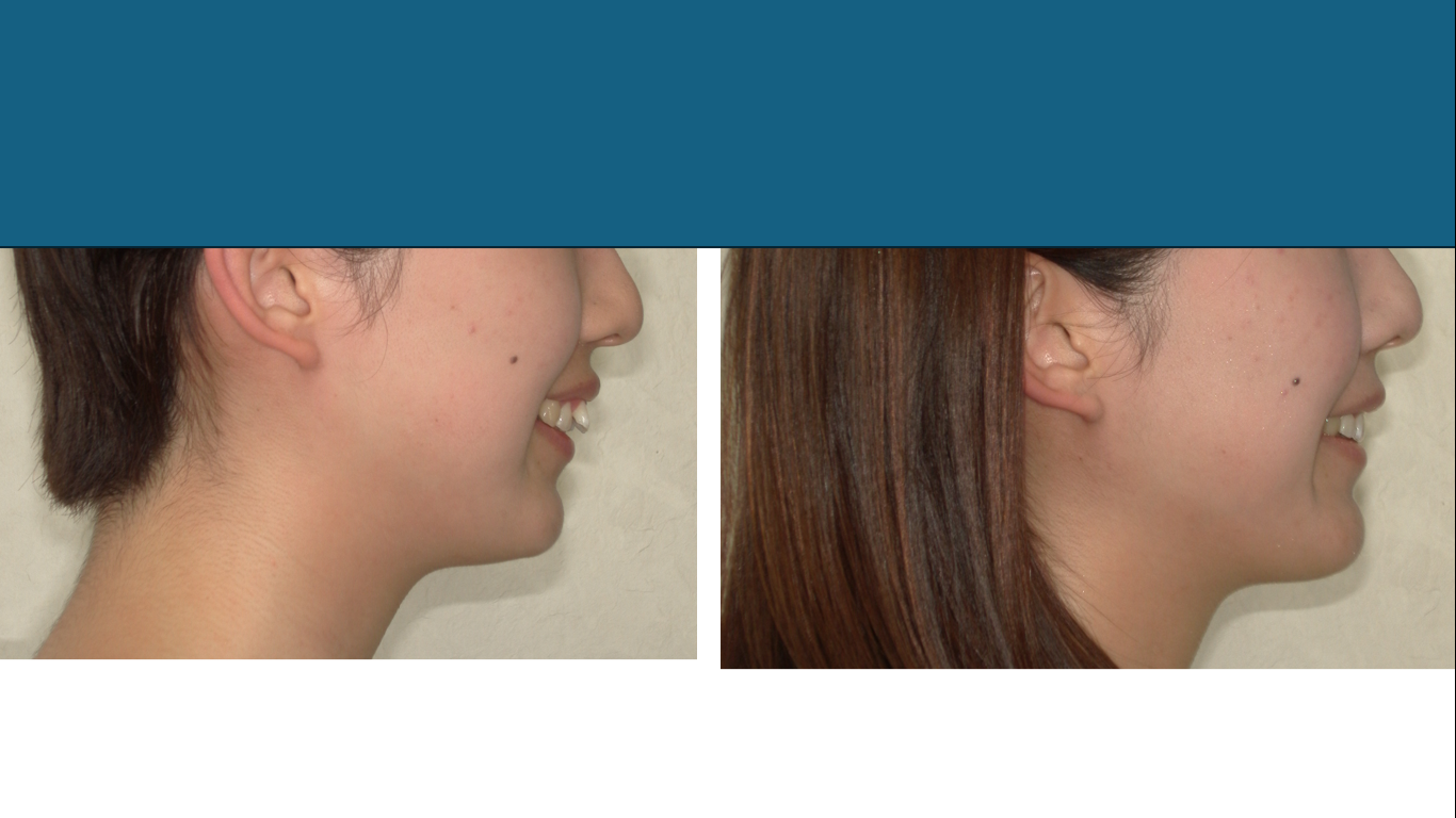 矯正症例147 AngleⅠ級 上顎前突　裏側矯正　舌側矯正