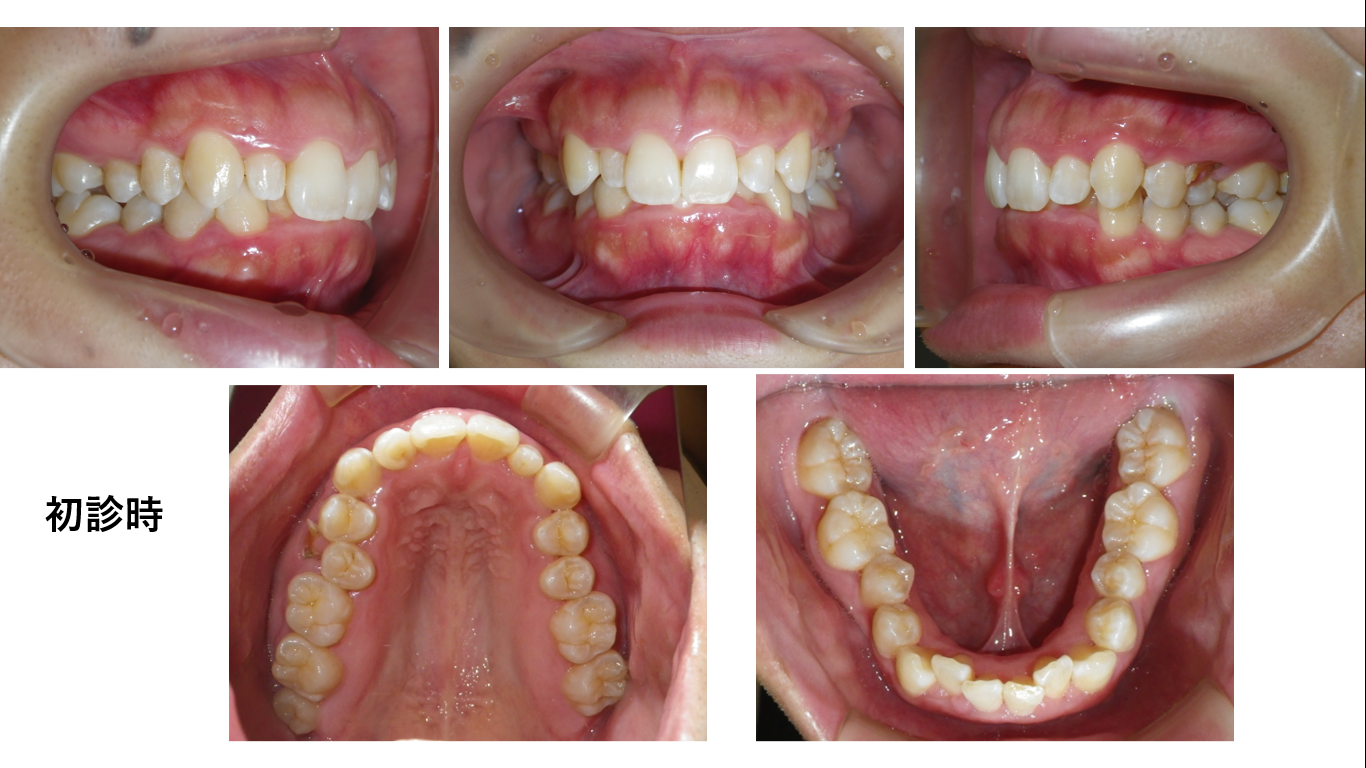 矯正症例143 AngleⅡ級2類