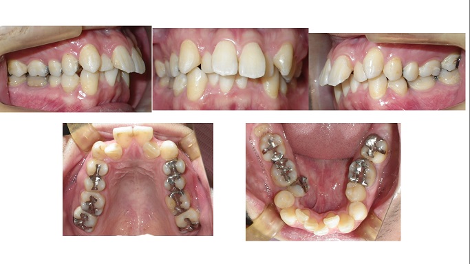 矯正症例59　出っ歯