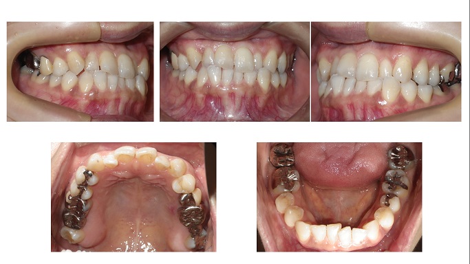 矯正症例51　下顎前突　叢生　能代市　北秋田市　大館市　