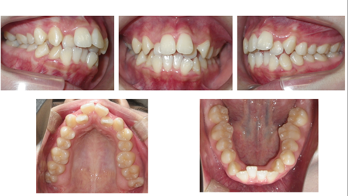 矯正症例64 Angle class Ⅱ 上顎前突 叢生 出っ歯 能代市 北秋田市  大館市 歯列矯正