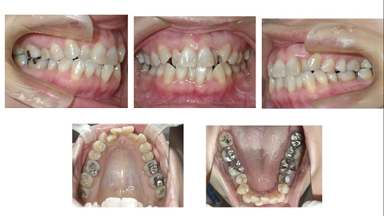 矯正症例55 舌側矯正 ハーフリンガル