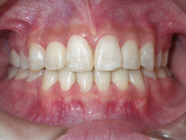 定期検診と虫歯の診断　小窩裂溝齲蝕　根面齲蝕  非活動性齲蝕