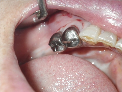 できるだけ歯を残します。抜歯しなければいけないと言われても残せるばあいがあります。炭酸ガスレーザーの使用法