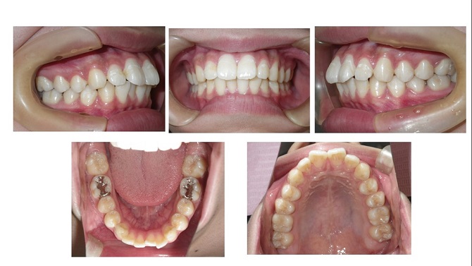 矯正症例60 上下顎前突　口元もっこり　