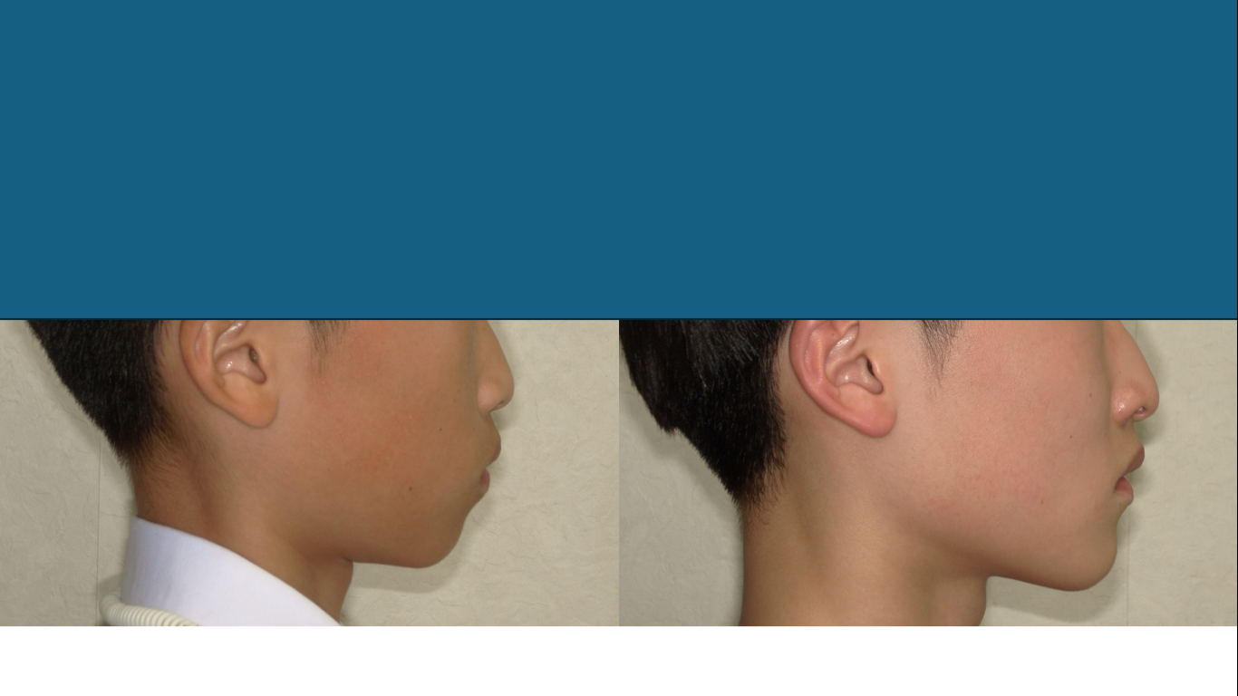 矯正症例148　AngleⅠ級上顎前突、裏側矯正、舌側矯正