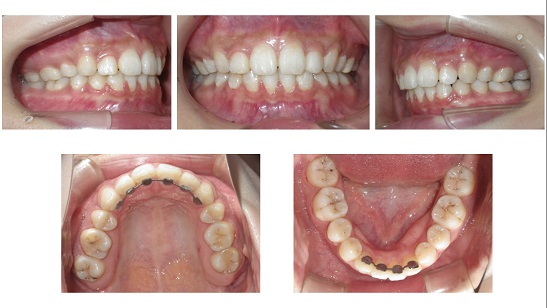 矯正症例52　上顎前突　他院のやり直し症例　インチキ矯正