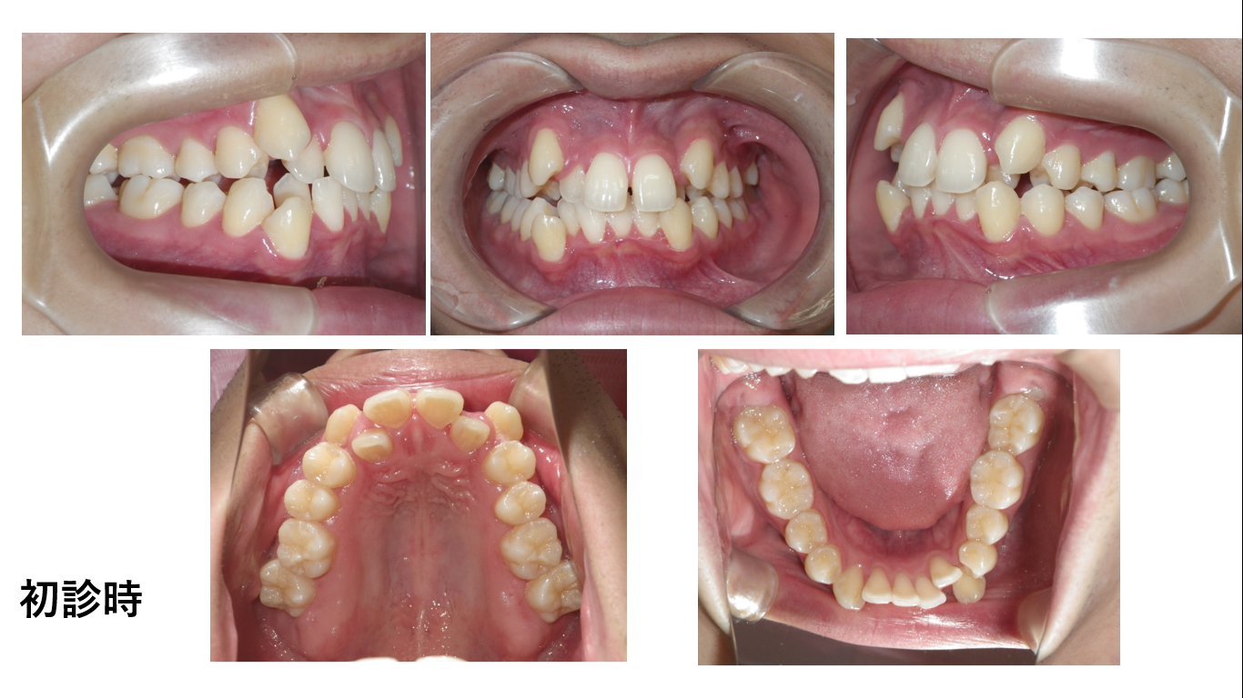 矯正症例102　AngleⅠ級叢生、秋田市、北秋田市、能代市,、大館市