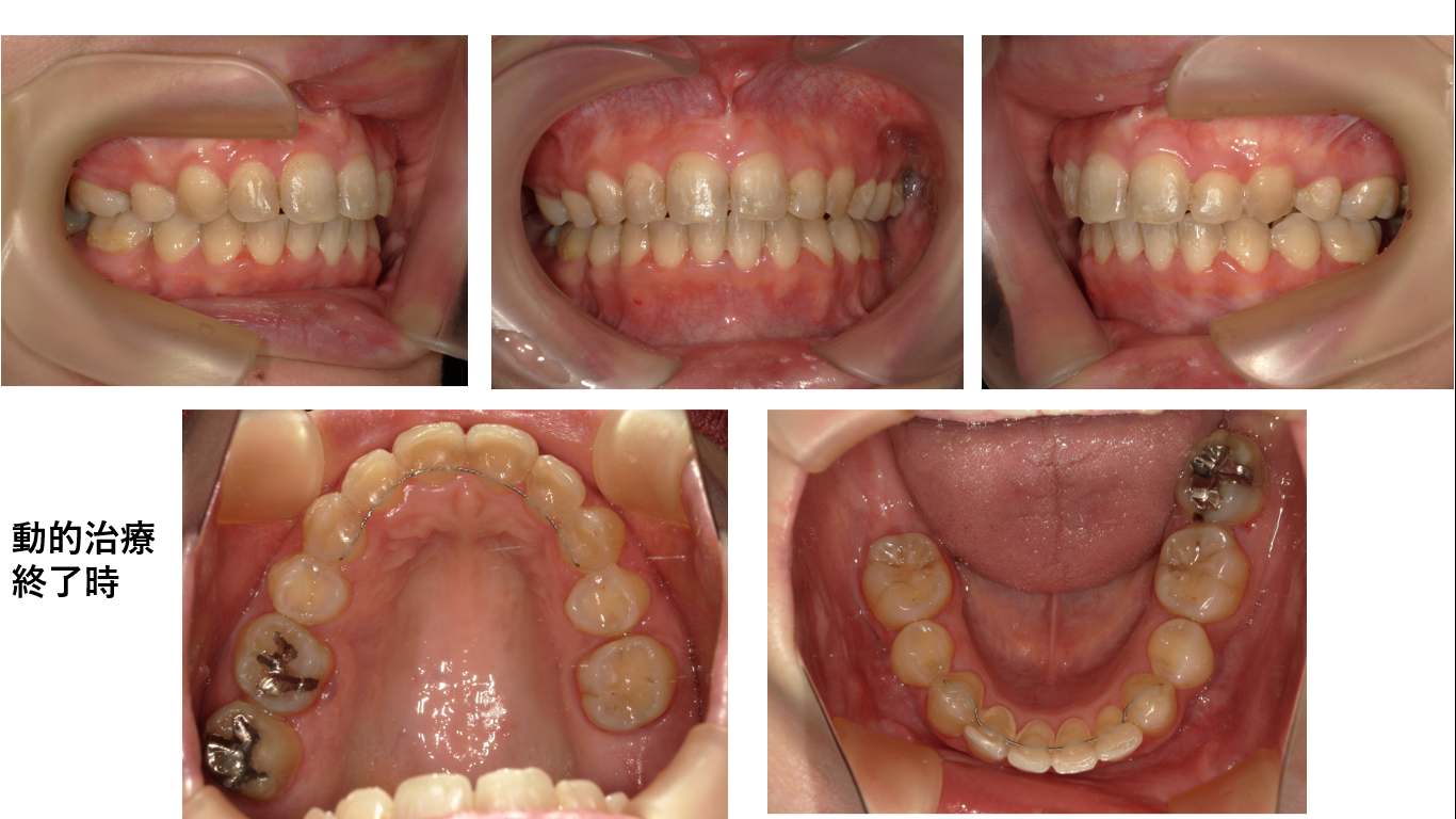 矯正症例145 叢生を伴うAngleⅡ級1類上顎前突