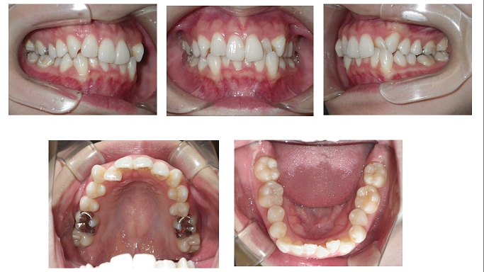 矯正症例71　Angle Ⅰ級叢生　ハーフリンガル症例