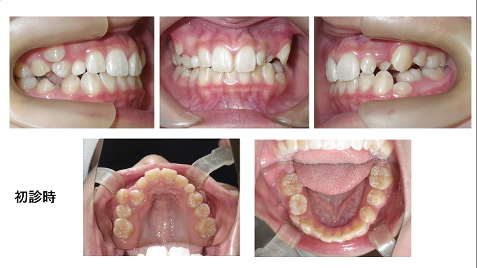 矯正症例93　AngleⅡ級叢生 秋田市、北秋田市、能代市、大館市