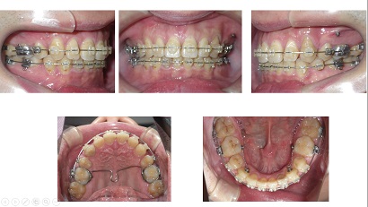 矯正ブログ２　上下顎前突 叢生