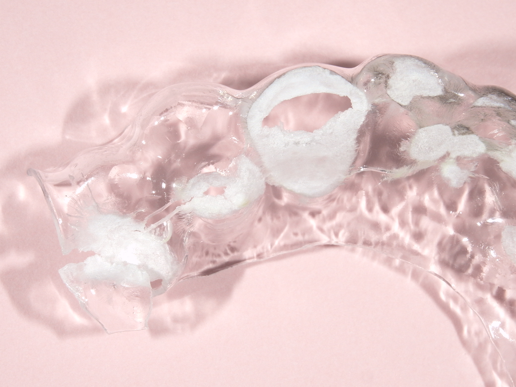 歯ぎしりのある患者にインプラントをして１４年経過