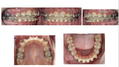 矯正ブログ３　叢生　上顎前突