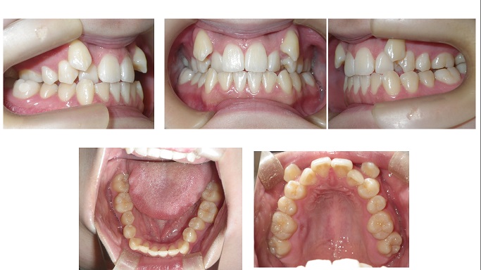 矯正症例61　骨格性下顎前突 叢生