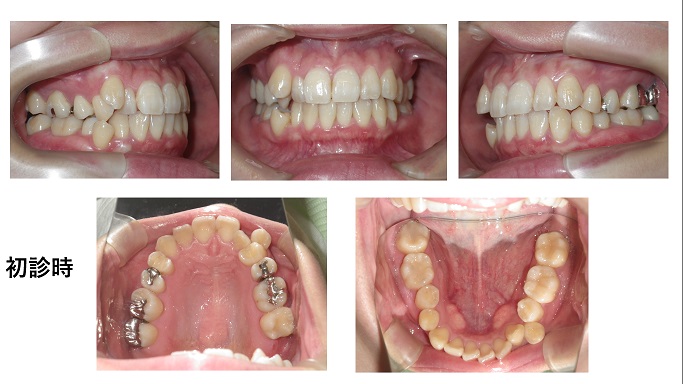 矯正症例100　AngleⅠ級叢生、能代市、北秋田市、秋田市、大館市