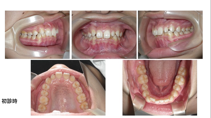矯正症例97　上顎右側側切歯に先天性欠如を伴う AngleⅠ級叢生、過蓋咬合、秋田市、北秋田市、大館市、能代市