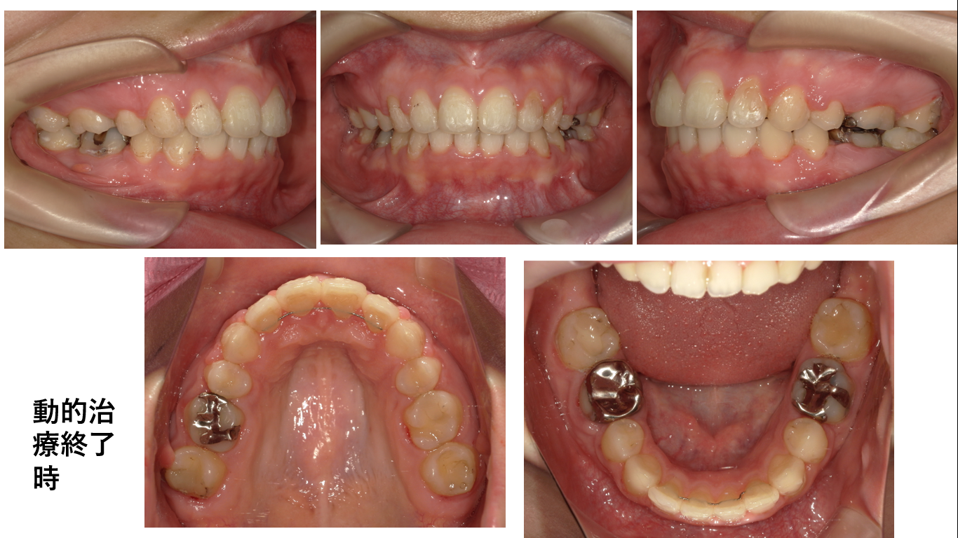 矯正症例138 AngleⅡ級1類 上顎前突
