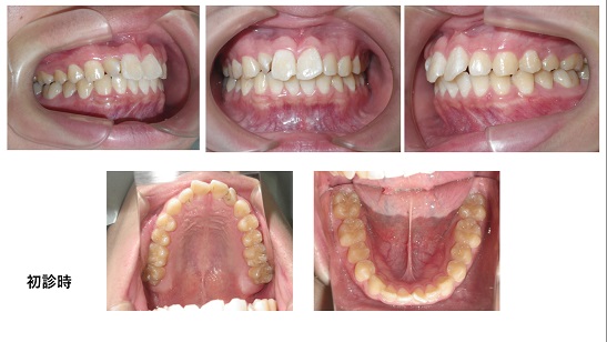 矯正症例84　AngleⅠ級　上顎前突、能代市、北秋田市、大館市、潟上市、秋田市