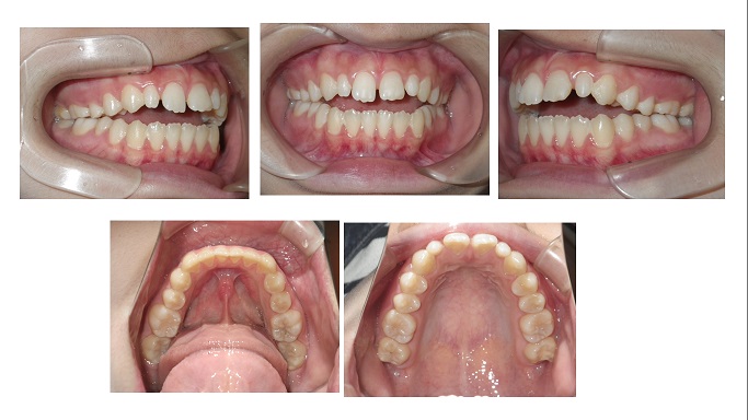 矯正症例68　開咬　オープンバイト