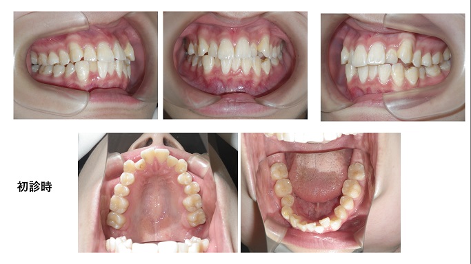 矯正症例98 AngleⅠ級叢生,秋田市、大館市、能代市、北秋田市
