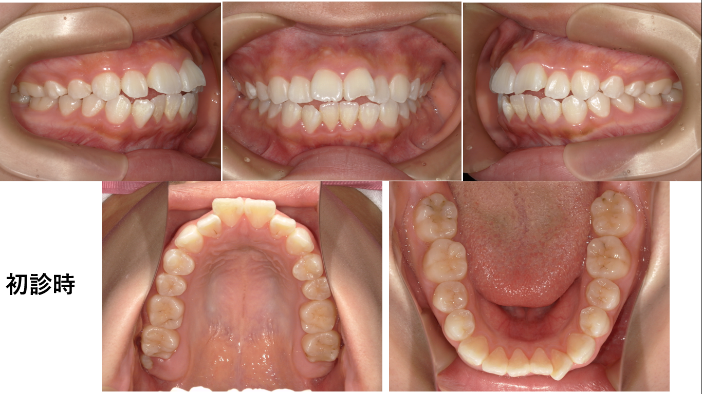 矯正症例141 AngleⅠ級 上下顎前突、ガミースマイル、口ごぼ