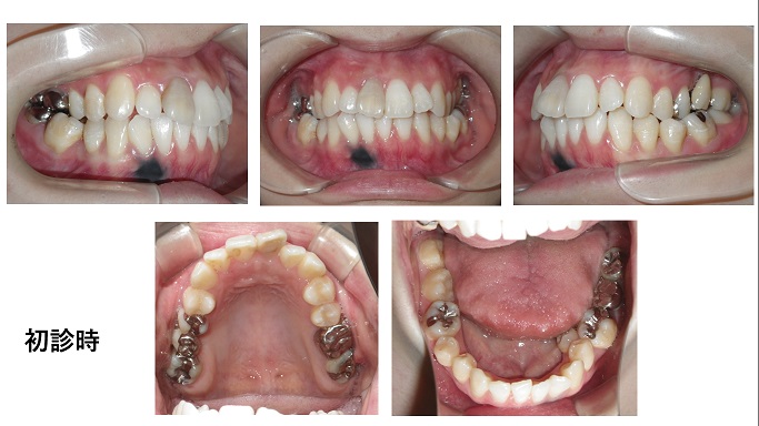 矯正症例87　上下顎前突　ハーフリンガル 裏側矯正　能代市、大館市、潟上市、北秋田市、秋田市