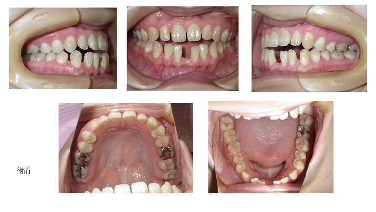 矯正症例80開咬、空隙歯列　能代市　北秋田市　大館市　秋田市