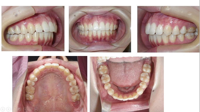 矯正症例70　AngleⅠ級上顎前突、下顎3本切歯症例、他院のやり直し