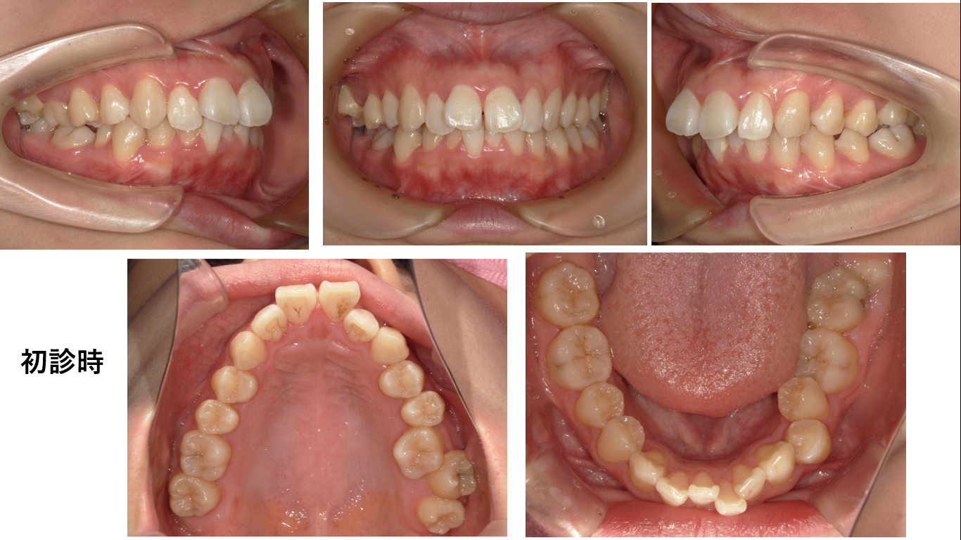 矯正症例147 AngleⅠ級 上顎前突　裏側矯正　舌側矯正