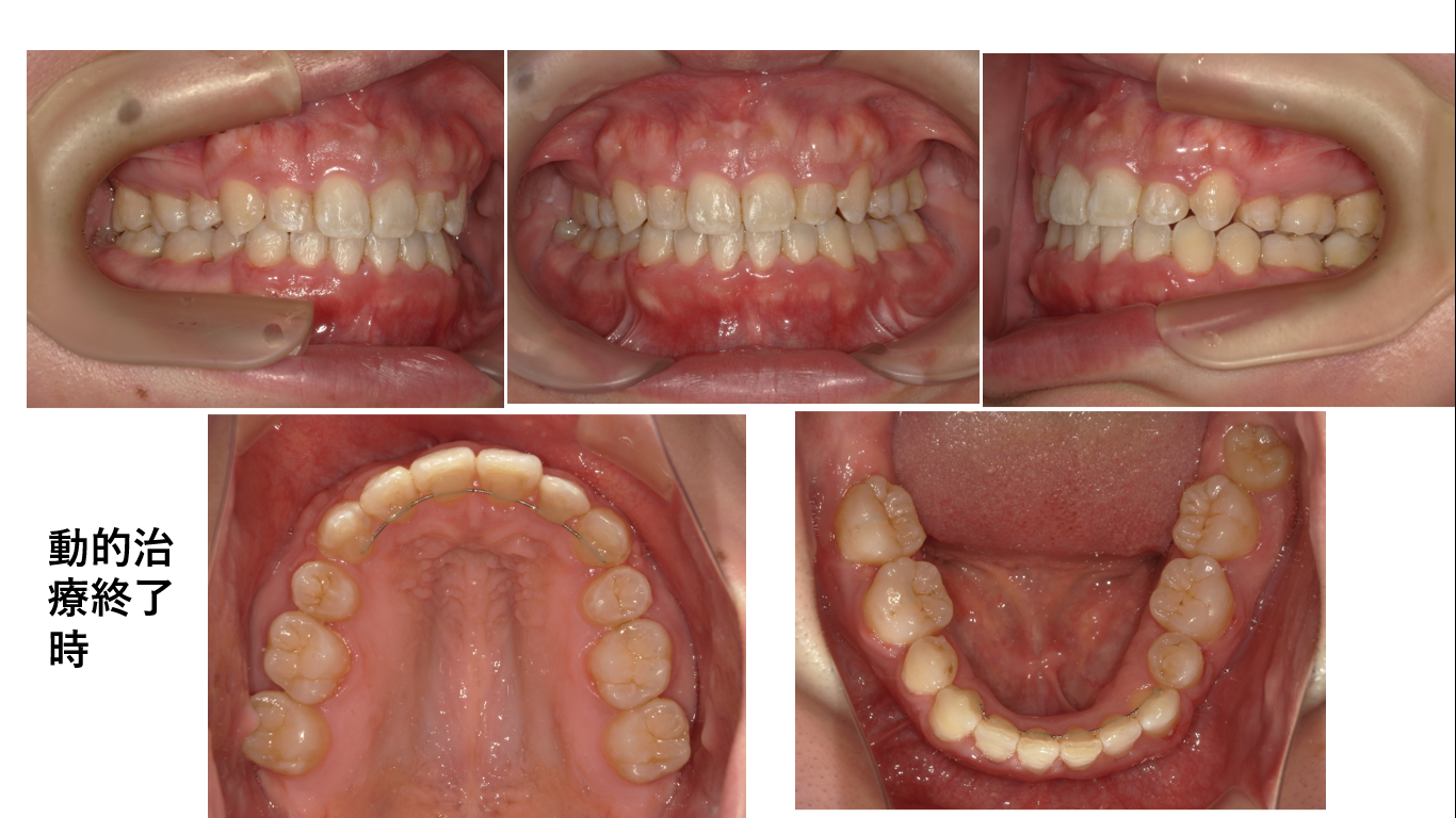 矯正症例143 AngleⅡ級2類