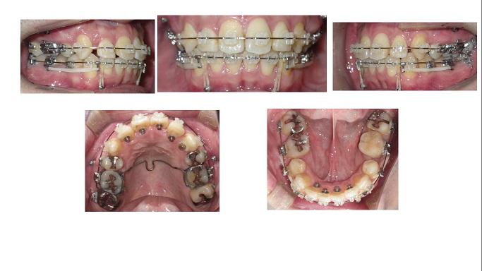 矯正ブログ１　上顎前突　過蓋咬合　叢生
